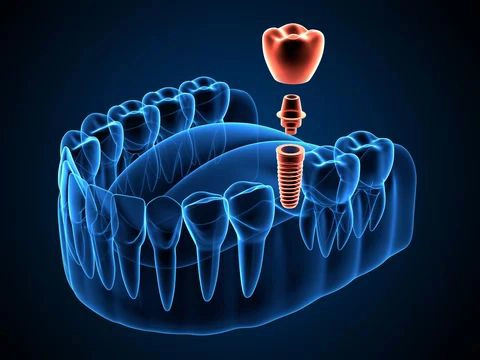 Dental Implants